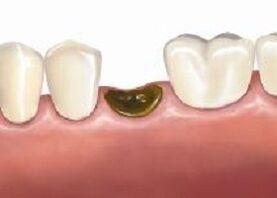 Complications après le feu des dents